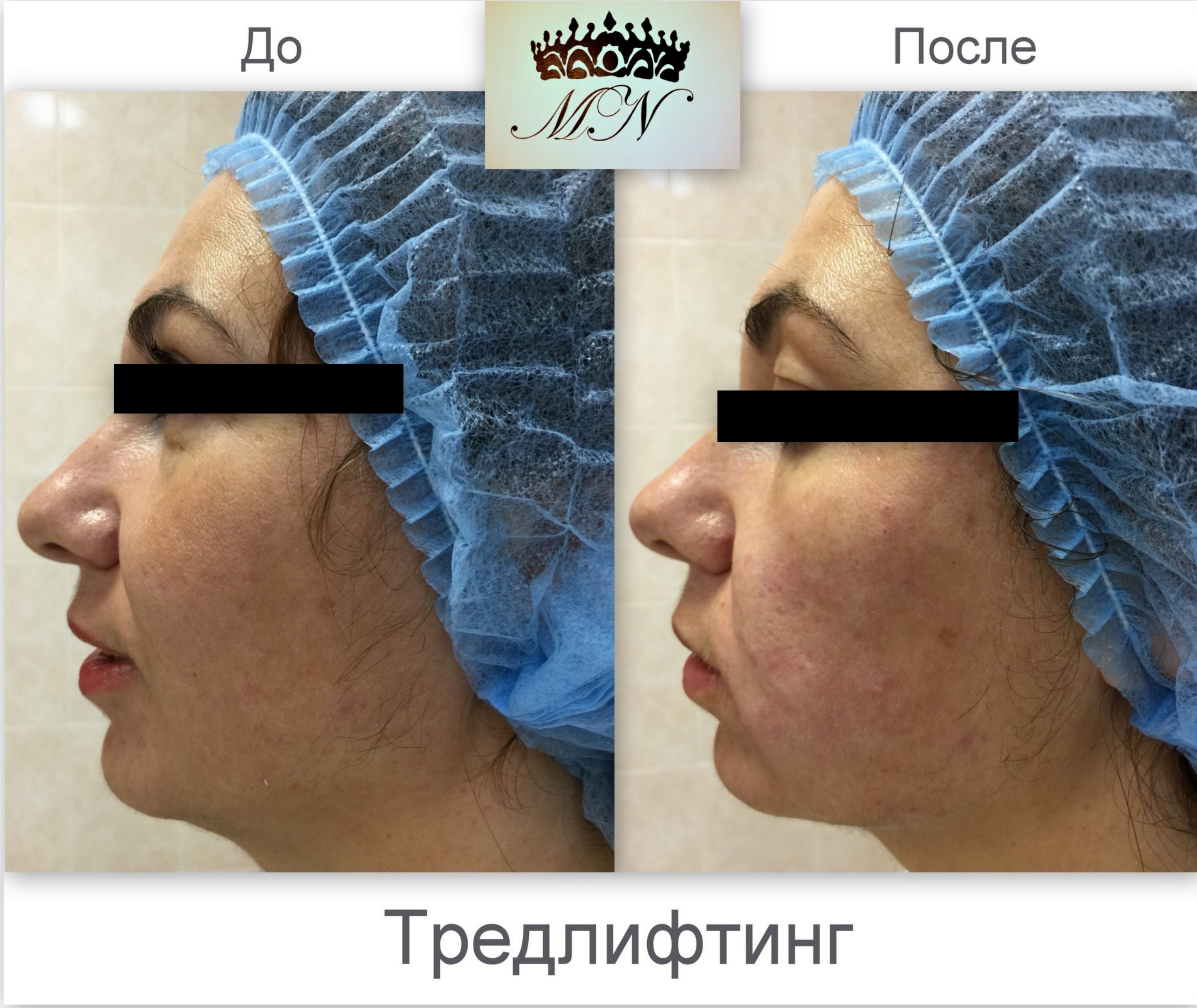 Тредлифтинг мезонитями до и после отзывы Тредлифтинг Мезонитями Отзывы Фото До И После - Mixyfotos.ru